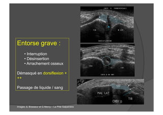 Entorse grave :
• Interruption
• Désinsertion
• Arrachement osseux
Démasqué en dorsiflexion +
++
Passage de liquide / sang
Images JL Brasseur et G Mercy – La Pitié Salpetrière
 