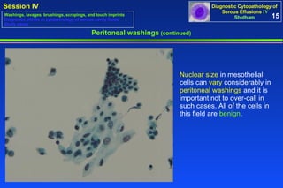 Peritoneal washings  (continued) Nuclear size  in mesothelial cells can  vary  considerably in  peritoneal washings  and it is important not to over-call in such cases. All of the cells in this field are  benign .  15 Washings, lavages, brushings, scrapings, and touch imprints Diagnostic pitfalls in cytopathology of serous cavity fluids Study cases 