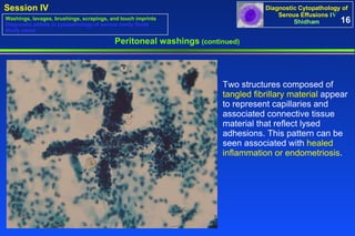 Peritoneal washings  (continued) Two structures composed of  tangled fibrillary material  appear to represent capillaries and associated connective tissue material that reflect lysed adhesions. This pattern can be seen associated with  healed inflammation or endometriosis .  16 Washings, lavages, brushings, scrapings, and touch imprints Diagnostic pitfalls in cytopathology of serous cavity fluids Study cases 