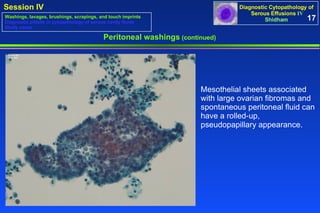 Peritoneal washings  (continued) Mesothelial sheets associated with large ovarian fibromas and spontaneous peritoneal fluid can have a rolled-up, pseudopapillary appearance.  17 Washings, lavages, brushings, scrapings, and touch imprints Diagnostic pitfalls in cytopathology of serous cavity fluids Study cases 