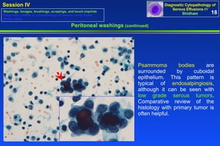 Peritoneal washings  (continued) Psammoma bodies  are surrounded by cuboidal epithelium. This pattern is typical of  endosalpingiosis , although it can be seen with  low grade serous tumors . Comparative review of the histology with primary tumor is often helpful.  18 Washings, lavages, brushings, scrapings, and touch imprints Diagnostic pitfalls in cytopathology of serous cavity fluids Study cases 