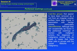 Peritoneal washings  (continued) Cast-like groups  that appear to have been removed as a unit from an irregular ovarian surface have been found in association with benign tumors, particularly  adenofibromas . Although they can occasionally be found in the peritoneal washings of women with malignant tumors, the diagnosis of malignancy should only be made in cases that have other cells or groups with the typical features of malignancy.  19 Washings, lavages, brushings, scrapings, and touch imprints Diagnostic pitfalls in cytopathology of serous cavity fluids Study cases 
