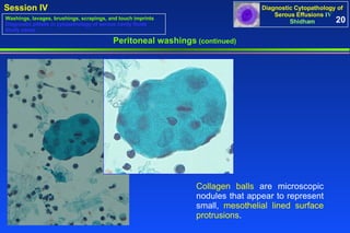 Peritoneal washings  (continued) Collagen balls  are microscopic nodules that appear to represent small,  mesothelial lined surface protrusions .  20 Washings, lavages, brushings, scrapings, and touch imprints Diagnostic pitfalls in cytopathology of serous cavity fluids Study cases 