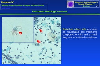 Peritoneal washings  (continued) Detached ciliary tufts   are seen as anucleated cell fragments composed of cilia and a small fragment of residual cytoplasm.  21 Washings, lavages, brushings, scrapings, and touch imprints Diagnostic pitfalls in cytopathology of serous cavity fluids Study cases 