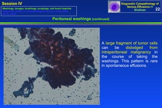 Peritoneal washings  (continued) A  large fragment of tumor cells  can be  dislodged from intraperitoneal malignancy  in the course of taking the washings. This pattern is rare in spontaneous effusions.  22 Washings, lavages, brushings, scrapings, and touch imprints Diagnostic pitfalls in cytopathology of serous cavity fluids Study cases 