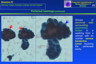 Peritoneal washings  (continued) Groups of  abnormal cells surrounding   psammoma bodies  in a washing from a woman with an ovarian  serous borderline tumor  involving the peritoneal cavity.  23 Washings, lavages, brushings, scrapings, and touch imprints Diagnostic pitfalls in cytopathology of serous cavity fluids Study cases 