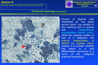 Peritoneal washings  (continued) Groups of atypical cells interpreted as “low grade serous tumor” are present in this washing from a woman with  intraperitoneal micropapillary serous tumor . While the cytologic pattern is that of a neoplasm, the  precise categorization is difficult by cytology alone . Indeed, it is unclear whether this lesion is a well differentiated carcinoma or a tumor of low malignant potential (borderline).  24 Washings, lavages, brushings, scrapings, and touch imprints Diagnostic pitfalls in cytopathology of serous cavity fluids Study cases 