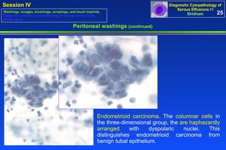 Peritoneal washings  (continued) Endometrioid carcinoma.  The  columnar cells  in the three-dimensional group, the  are haphazardly arranged  with dyspolaric nuclei. This distinguishes endometrioid carcinoma from benign tubal epithelium.  25 Washings, lavages, brushings, scrapings, and touch imprints Diagnostic pitfalls in cytopathology of serous cavity fluids Study cases 