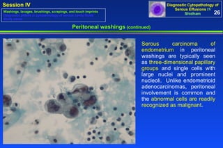 Peritoneal washings  (continued) Serous carcinoma of endometrium  in peritoneal washings are typically seen as  three-dimensional papillary groups  and single cells with large nuclei and prominent nucleoli.  Unlike endometrioid adenocarcinomas, peritoneal involvement is common and the  abnormal cells are readily recognized as malignant .  26 Washings, lavages, brushings, scrapings, and touch imprints Diagnostic pitfalls in cytopathology of serous cavity fluids Study cases 