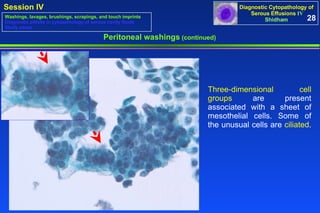 Peritoneal washings  (continued) Three-dimensional cell groups  are present associated with a sheet of mesothelial cells. Some of the unusual cells are  ciliated .  28 Washings, lavages, brushings, scrapings, and touch imprints Diagnostic pitfalls in cytopathology of serous cavity fluids Study cases 