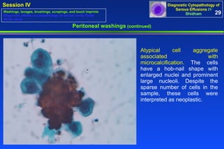 Peritoneal washings  (continued) Atypical cell aggregate associated with microcalcification.  The cells have a hob-nail shape with enlarged nuclei and prominent large nucleoli. Despite the sparse number of cells in the sample, these cells were interpreted as neoplastic.  29 Washings, lavages, brushings, scrapings, and touch imprints Diagnostic pitfalls in cytopathology of serous cavity fluids Study cases 