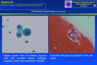 Peritoneal washings  (continued) Higher power view of isolated atypical cells with rounded shape, enlarged irregular nuclei and prominent nucleoli.  A similar cell group is present in the cell block.  30 Washings, lavages, brushings, scrapings, and touch imprints Diagnostic pitfalls in cytopathology of serous cavity fluids Study cases 