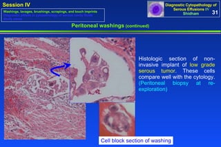 Peritoneal washings  (continued) Histologic section of non-invasive implant of  low grade serous tumor . These cells compare well with the cytology.  (Peritoneal biopsy at re-exploration) 31 Washings, lavages, brushings, scrapings, and touch imprints Diagnostic pitfalls in cytopathology of serous cavity fluids Study cases Cell block section of washing 
