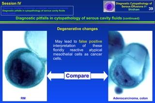 Diagnostic pitfalls in cytopathology of serous cavity fluids  (continued) Degenerative changes 39 Washings, lavages, brushings, scrapings, and touch imprints Diagnostic pitfalls in cytopathology of serous cavity fluids Study cases May lead to  false positive  interpretation of these floridly reactive atypical mesothelial cells as cancer cells. RM Adenocarcinoma, colon Compare 
