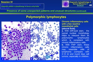 Presence of some unexpected patterns and unusual structures  (continued) Polymorphic lymphocytes Chronic inflammatory cells with a few reactive mesothelial cells  (pleural fluid).  a.  With Diff-Quik stain,  the typical nuclear morphology helps to interpret them as polymorphic lymphocytes which is consistent with chronic inflammatory cells. b.  With PAP stain, these chronic inflammatory cells may resemble cells of lymphoma (compare with 4.12 d) and round blue cell tumors, especially in children.  46 Washings, lavages, brushings, scrapings, and touch imprints Diagnostic pitfalls in cytopathology of serous cavity fluids Study cases a b RM RM 
