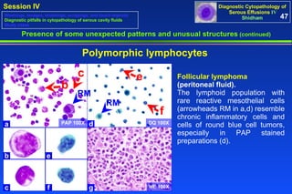 Presence of some unexpected patterns and unusual structures  (continued) Follicular lymphoma  (peritoneal fluid).  The lymphoid population with rare reactive mesothelial cells (arrowheads RM in a,d) resemble chronic inflammatory cells and cells of round blue cell tumors, especially in PAP stained preparations (d).  Polymorphic lymphocytes 47 Washings, lavages, brushings, scrapings, and touch imprints Diagnostic pitfalls in cytopathology of serous cavity fluids Study cases PAP 100X a b RM c d e f g c b e f RM DQ 100X HE 100X 