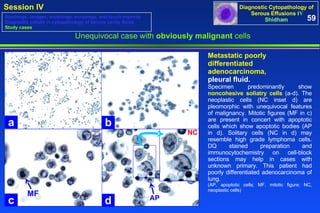 Unequivocal case with  obviously malignant  cells Metastatic poorly differentiated adenocarcinoma,  pleural fluid.  Specimen predominantly show  noncohesive soliatry cells  (a-d). The neoplastic cells (NC inset d) are pleomorphic with unequivocal features of malignancy. Mitotic figures (MF in c) are present in concert with apoptotic cells which show apoptotic bodies (AP in d). Solitary cells (NC in d) may resemble high grade lymphoma cells. DQ stained preparation and immunocytochemistry on cell-block sections may help in cases with unknown primary. This patient had poorly differentiated adenocarcinoma of lung.  (AP, apoptotic cells; MF, mitotic figure; NC, neoplastic cells) 59 Washings, lavages, brushings, scrapings, and touch imprints Diagnostic pitfalls in cytopathology of serous cavity fluids Study cases a b d c AP MF NC 