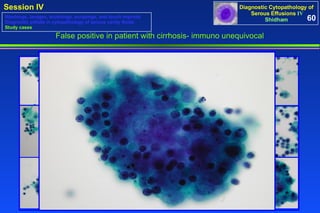 False positive in patient with cirrhosis- immuno unequivocal 60 Washings, lavages, brushings, scrapings, and touch imprints Diagnostic pitfalls in cytopathology of serous cavity fluids Study cases 