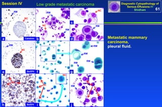 Low grade metastatic carcinoma Metastatic mammary carcinoma,   pleural fluid. 61 Calretinin RM NC BerEP4 RM NC NC BerEP4 NC NC NC RM g i h f e c a j b d MF RM NC RM RM RM RM RM NC RM 