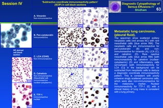 ‘ Subtractive coordinate immunoreactivity pattern’  (SCIP) in cell block sections Metastatic lung carcinoma,  (pleural fluid).  The specimen show scattered  solitary  neoplastic cells (red arrows NC) with  rare  mesothelial cells (blue arrow RM). The neoplastic cells are immunoreactive for pan-cytokeratin (B) and non-immunoreactive for vimentin (A), LCA (C), and calretinin (D). Rare reactive mesothelial cells (blue arrow RM) [with immunoreactivity for calretinin (nuclear-cytoplasmic) (D) and inflammatory cells (arrowhead) [with immunoreactivity for LCA (C)] in the background can be subtracted from neoplastic cells to deduce a diagnostic coordinate immunoreactivity pattern. This is consistent with poorly cohesive singly scattered carcinoma cells, which were also non-immunoreactive for the melanoma marker. Nuclear immunoreactivity for TTF-1 (E) with a clinical history of lung mass is consistent with a lung primary.   63 HE stained cell block section 40X 100X D. Calretinin Non-immunoreactive (Mesothelial cell-  immunoreactive nuclear-cytoplasmic) E. TTF-1 Immunoreactive nuclear 40X 100X B. Pan-cytokeratin Immunoreactive C. LCA (CD45) Non-immunoreactive 40X 40X 100X 100X 40X 100X A. Vimentin Non-immunoreactive NC RM NC RM NC 