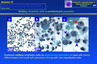 Solitary  neoplastic cells as  predominan t population 64 Washings, lavages, brushings, scrapings, and touch imprints Diagnostic pitfalls in cytopathology of serous cavity fluids Study cases Scattered   solitary   neoplastic cells as  predominant population  in case with  poorly differentiated non-small cell carcinoma of lung  with  rare  mesothelial cells. a 10X b 40X c NC 
