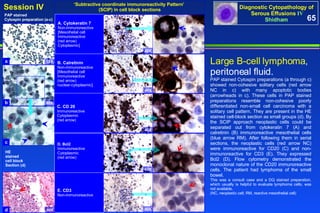 Large B-cell lymphoma ,  peritoneal fluid.  PAP stained Cytospin preparations (a through c) showed non-cohesive solitary cells (red arrow NC in c) with many apoptotic bodies (arrowheads in c). These cells in PAP stained preparations resemble non-cohesive poorly differentiated non-small cell carcinoma with a solitary cell pattern. They are present in the HE stained cell-block section as small groups (d). By the SCIP approach neoplastic cells could be separated out from cytokeratin 7 (A) and calretinin (B) immunoreactive mesothelial cells (blue arrow RM). After following them in serial sections, the neoplastic cells (red arrow NC) were immunoreactive for CD20 (C) and non-immunoreactive for CD3 (E). They expressed Bcl2 (D). Flow cytometry demonstrated the monoclonal nature of the CD20 immunoreactive cells. The patient had lymphoma of the small bowel.  This was a consult case and a DQ stained preparation, which usually is helpful to evaluate lymphoma cells, was not available.  (NC, neoplastic cell; RM, reactive mesothelial cell) ‘ Subtractive coordinate immunoreactivity Pattern’  (SCIP) in cell block sections 65 HE stained  cell block Section (d) A. Cytokeratin 7 Non-immunoreactive [Mesothelial cell  Immunoreactive  (red arrow) Cytoplasmic] B. Calretinin Non-immunoreactive [Mesothelial cell  Immunoreactive  (red arrow) nuclear-cytoplasmic] D. Bcl2 Immunoreactive Cytoplasmic  (red arrow) E. CD3 Non-immunoreactive C. CD 20 Immunoreactive Cytoplasmic  (red arrow) PAP stained  Cytospin preparation (a-c) 40X 40X 40X 40X 40X a b c d 10X 40X NC NC RM NC RM NC NC 40X 