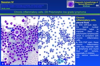 Chronic inflammatory cells- DD Polymorphic low grade lymphoma Chronic inflammatory cells,  pleural fluid.  a.  With Diff-Quik stain,  the typical nuclear morphology helps to interpret them as polymorphic lymphocytes which is consistent with chronic inflammatory cells. b.  With PAP stain, these chronic inflammatory cells may resemble cells of lymphoma and round blue cell tumors, especially in children.  (RM, reactive mesothelial cell) 66 Washings, lavages, brushings, scrapings, and touch imprints Diagnostic pitfalls in cytopathology of serous cavity fluids Study cases a b RM RM 
