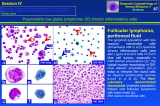 Polymorphic low grade lymphoma- DD chronic inflammatory cells Follicular lymphoma, peritoneal fluid The lymphoid population with rare reactive mesothelial cells (arrowheads RM in a,d) resemble chronic inflammatory cells (see also Figure 4.9) and cells of round blue cell tumors, especially in PAP stained preparations (d). The typical nuclear morphology in Diff-Quik stained preparation (a,b,c) helps to interpret the round cells as atypical lymphocytes (arrows b,c,e,f in a & d). The  flow-cytometry demonstrated monoclonal  lymphoid population. Patient had follicular lymphoma with colon mass (g).  (RM, reactive mesothelial cells) PAP 100X a b RM c d e f g c b e f RM DQ 100X HE 100X 67 Washings, lavages, brushings, scrapings, and touch imprints Diagnostic pitfalls in cytopathology of serous cavity fluids Study cases 