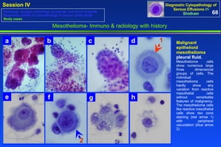 Mesothelioma- Immuno & radiology with history Malignant epithelioid mesothelioma  pleural fluid. Mesothelioma cells show numerous large three dimensional groups of cells. The individual mesothelioma cells hardly show any variation from reactive mesothelial cells without remarkable features of malignancy. The mesothelioma cells like reactive mesothelial cells show two zone staining (red arrow 1) with peripheral vacuolation (blue arrow 2).  68 Washings, lavages, brushings, scrapings, and touch imprints Diagnostic pitfalls in cytopathology of serous cavity fluids Study cases 1 2 a b c e f g h d 