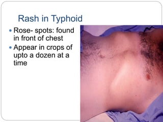 Rash in Typhoid
 Rose- spots: found
in front of chest
 Appear in crops of
upto a dozen at a
time
 