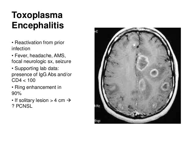 Aids Ring Enhancing Brain Lesion Aids Ring Enhancing Brain Lesion