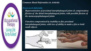Occupational Therapy And Rheumatoid Arthritis
