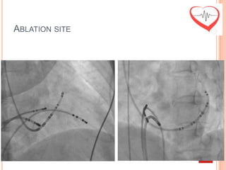 ABLATION SITE
 