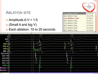 ABLATION SITE
 Amplitude A:V = 1:5
 (Small A and big V)

 Each ablation: 10 to 20 seconds
 