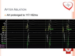 AFTER ABLATION
   AH prolonged to 117-162ms
 