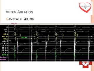 AFTER ABLATION
   AVN WCL: 490ms
 