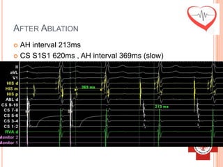 AFTER ABLATION
 AH interval 213ms
 CS S1S1 620ms , AH interval 369ms (slow)
 