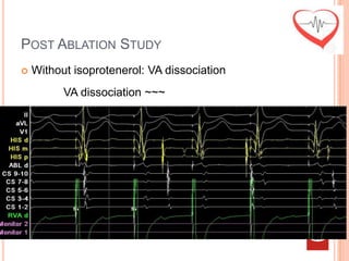 POST ABLATION STUDY
   Without isoprotenerol: VA dissociation
          VA dissociation ~~~
 