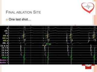 FINAL ABLATION SITE
   One last shot…
 