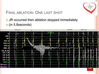 FINAL ABLATION- ONE LAST SHOT
 JR occurred then ablation stopped immediately
 (in 5.8seconds)
 
