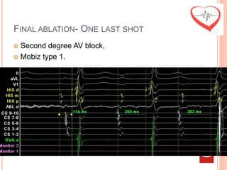 FINAL ABLATION- ONE LAST SHOT
 Second degree AV block,
 Mobiz type 1.
 