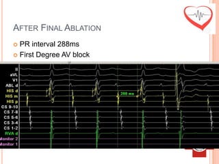 AFTER FINAL ABLATION
 PR interval 288ms
 First Degree AV block
 