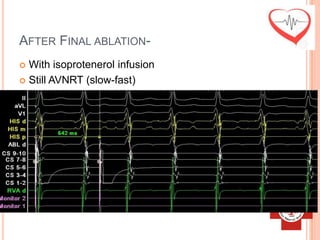 AFTER FINAL ABLATION-
 With isoprotenerol infusion
 Still AVNRT (slow-fast)
 