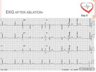 EKG AFTER ABLATION-
                      Day 0
 