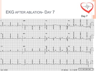 EKG AFTER ABLATION- DAY 7
                            Day 7
 