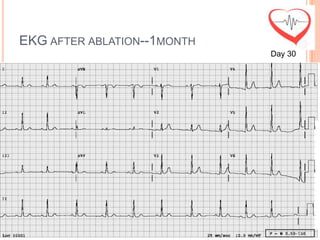 EKG AFTER ABLATION--1MONTH
                             Day 30
 