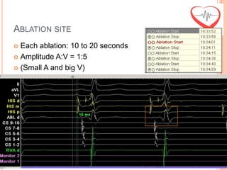 ABLATION SITE
 Each ablation: 10 to 20 seconds
 Amplitude A:V = 1:5

 (Small A and big V)
 