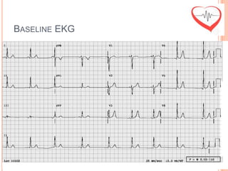 BASELINE EKG
 