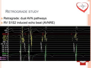 RETROGRADE STUDY
 Retragrade: dual AVN pathways
 RV S1S2 induced echo beat (AVNRE)
 