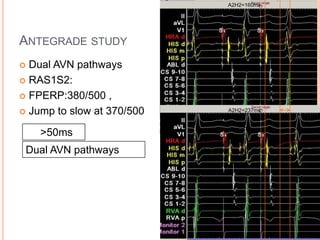 A2H2=160ms




ANTEGRADE STUDY
 Dual AVN pathways
 RAS1S2:

 FPERP:380/500 ,

 Jump to slow at 370/500   A2H2=237ms



    >50ms
 Dual AVN pathways
 